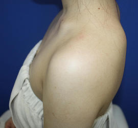 20代女性のボトックス（美肩・肩こり解消） Before 症例写真