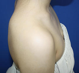 20代女性のボトックス（美肩・肩こり解消） Before 症例写真