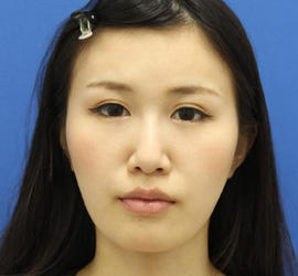 20代女性の顔の脂肪吸引 After 症例写真