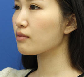 20代女性の顔の脂肪吸引  After 症例写真