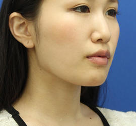 20代女性の顔の脂肪吸引  After 症例写真