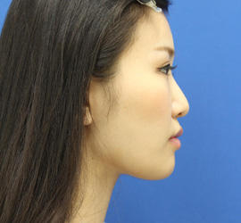 20代女性の顔の脂肪吸引  After 症例写真