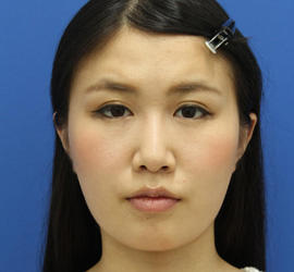 20代女性の顔の脂肪吸引 Before 症例写真