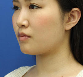20代女性の顔の脂肪吸引  Before 症例写真
