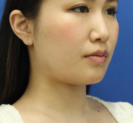 20代女性の顔の脂肪吸引  Before 症例写真