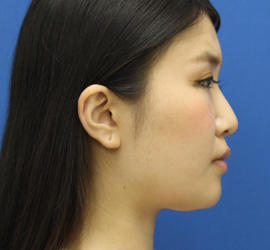 20代女性の顔の脂肪吸引  Before 症例写真