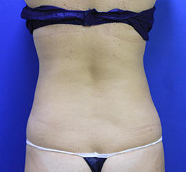 30代女性の脂肪吸引 After 症例写真