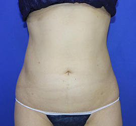 30代女性の脂肪吸引 After 症例写真