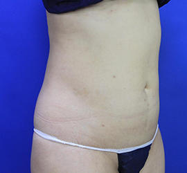 30代女性の脂肪吸引 After 症例写真
