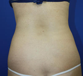 30代女性の脂肪吸引 Before 症例写真