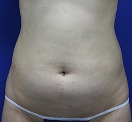 30代女性の脂肪吸引 Before 症例写真