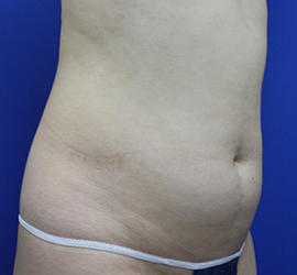 30代女性の脂肪吸引 Before 症例写真