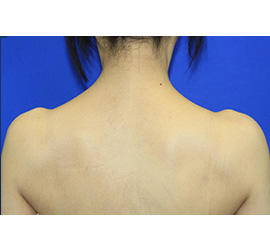 40代女性のボトックス（美肩・肩こり解消） After 症例写真