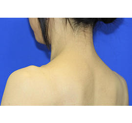 40代女性のボトックス（美肩・肩こり解消） After 症例写真