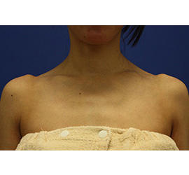 40代女性のボトックス（美肩・肩こり解消） Before 症例写真