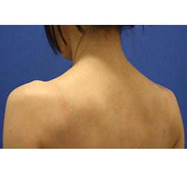 40代女性のボトックス（美肩・肩こり解消） Before 症例写真