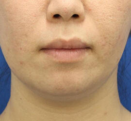 30代女性の小林式ニキビ治療法 After 症例写真