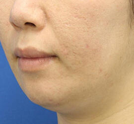 30代女性の小林式ニキビ治療法 After 症例写真