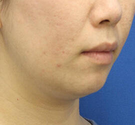 30代女性の小林式ニキビ治療法 After 症例写真