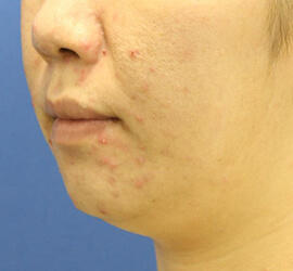 30代女性の小林式ニキビ治療法 Before 症例写真