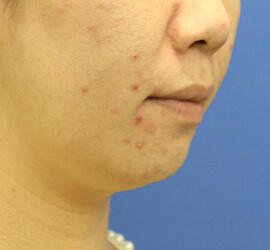 30代女性の小林式ニキビ治療法 Before 症例写真