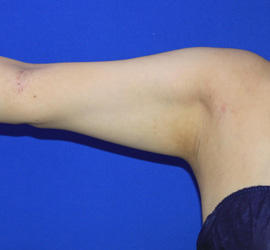 20代女性の脂肪吸引 After 症例写真