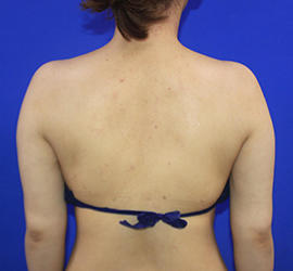 20代女性の脂肪吸引 After 症例写真