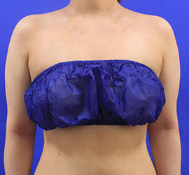 20代女性の脂肪吸引 After 症例写真