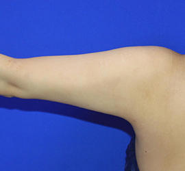 20代女性の脂肪吸引 After 症例写真