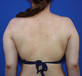 20代女性の脂肪吸引 Before 症例写真