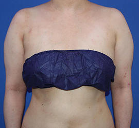 20代女性の脂肪吸引 Before 症例写真