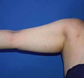 20代女性の脂肪吸引 Before 症例写真