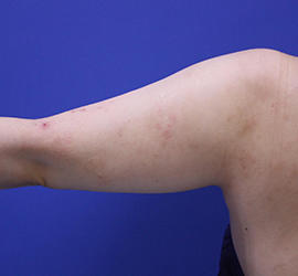 20代女性の脂肪吸引 Before 症例写真