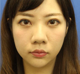 20代女性の目の下のクマ治療 After 症例写真