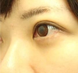 20代女性の3Dリポアイリフト  After 症例写真