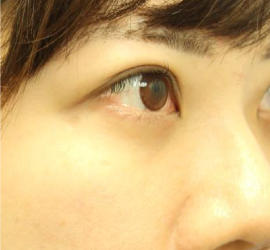 20代女性の3Dリポアイリフト  After 症例写真