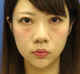 20代女性の目の下のクマ治療 Before 症例写真