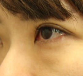 20代女性の3Dリポアイリフト  Before 症例写真