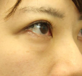 20代女性の3Dリポアイリフト  Before 症例写真