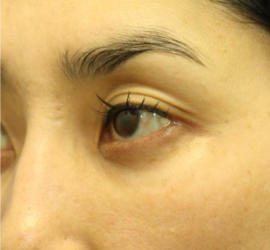 40代女性の3Dリポアイリフト  After 症例写真