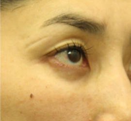 40代女性の3Dリポアイリフト  After 症例写真