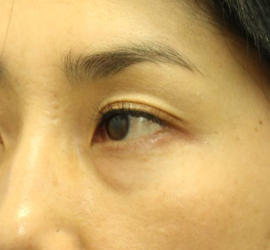 40代女性の3Dリポアイリフト  Before 症例写真