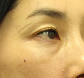 40代女性の3Dリポアイリフト  Before 症例写真