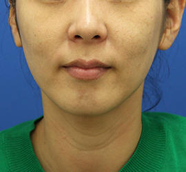 30代女性のシワ・たるみ After 症例写真