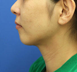 30代女性の顔の脂肪吸引  After 症例写真