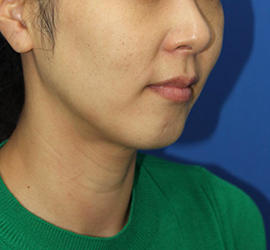 30代女性の顔の脂肪吸引  After 症例写真