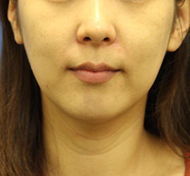 30代女性のシワ・たるみ Before 症例写真