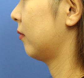 30代女性の顔の脂肪吸引  Before 症例写真