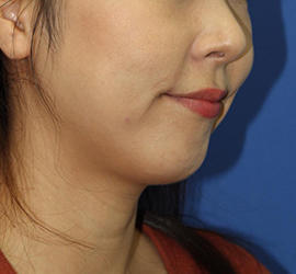 30代女性の顔の脂肪吸引  Before 症例写真