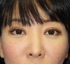 40代女性の目の下のクマ治療 After 症例写真